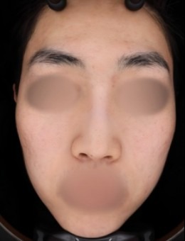 韩国GreenY皮肤科实例对比图：痘痘、痘印及皮肤粗糙明显改善了不少！