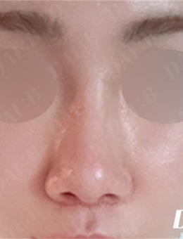 韩国Dal:B整形做鼻子好吗，来看看真人实例对比图，很惊艳！