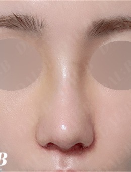 韩国Dal:B整形做鼻子好吗，来看看真人实例对比图，很惊艳！