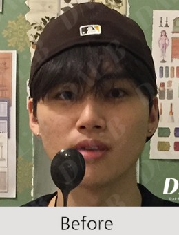 在韩国Dal b达尔比整形外科的蜕变之旅!轮廓柔和后秒变小鲜肉