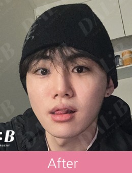 在韩国Dal b达尔比整形外科的蜕变之旅!轮廓柔和后秒变小鲜肉