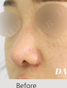 韩国Dal:B整形做鼻子整形很拿手，技术和口碑都值得放心！