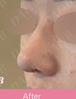 韩国Dal:B整形做鼻子整形很拿手，技术和口碑都值得放心！