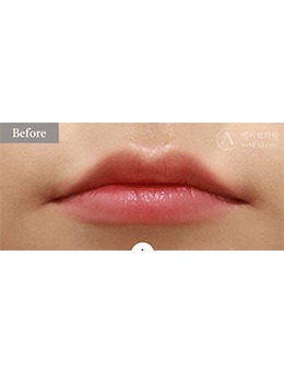 被韩国Alive皮肤科的丰唇术惊艳到！从干瘪唇到饱满唇的逆袭，美到犯规！