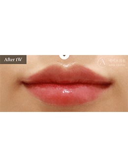 被韩国Alive皮肤科的丰唇术惊艳到！从干瘪唇到饱满唇的逆袭，美到犯规！