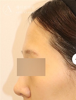 韩国AIVE皮肤科额头填充前后对比真的绝了！1周解锁温柔饱满侧颜