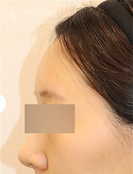 韩国AIVE皮肤科额头填充前后对比真的绝了！1周解锁温柔饱满侧颜