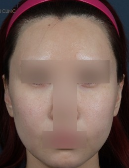 韓國ever皮膚科鈦提升+美版刀+填充+線提拉等聯(lián)合方案實例：看膚質(zhì)輪廓雙改善！