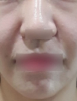 法令紋淡化實(shí)錄：韓國EVER皮膚科透明質(zhì)酸酶改善實(shí)例全解析