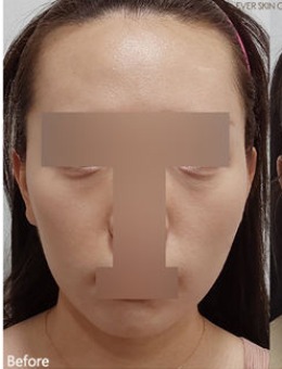 韓國(guó)Ever皮膚科眼底+臉頰填充真實(shí)術(shù)例解析:告別凹陷,重拾飽滿(mǎn)元?dú)?>
                                        <img src=