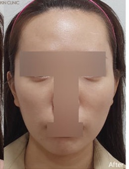 韩国Ever皮肤科眼底+脸颊填充真实术例解析:告别凹陷,重拾饱满元气