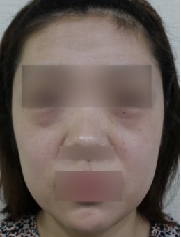 韓國ever皮膚科術例大公開：臉頰一填，年輕飽滿全都有！