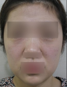 韓國ever皮膚科術例大公開：臉頰一填，年輕飽滿全都有！