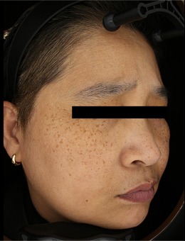 韩国夏恩皮肤科祛斑前后对比照公开，斑点淡化明显肤色透亮，真实结果一目了然！