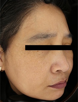 韩国夏恩皮肤科祛斑前后对比照公开，斑点淡化明显肤色透亮，真实结果一目了然！