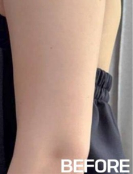 韩国夏恩医院一日瘦胳膊记录!施术后与手臂拜拜肉说再见~