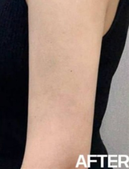 韩国夏恩医院一日瘦胳膊记录!施术后与手臂拜拜肉说再见~