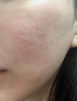 韩国夏恩医院痘坑毛孔治疗技术好，juvelook+Air Dissector+疤痕玻尿酸项目开启肌肤高光时刻！