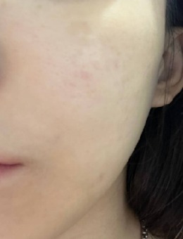 韩国夏恩医院痘坑毛孔治疗技术好，juvelook+Air Dissector+疤痕玻尿酸项目开启肌肤高光时刻！