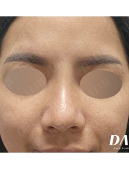 韩国Dal:B整形｜鼻整形前后对比真实体验，自然精致不撞脸