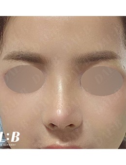韩国Dal:B整形｜鼻整形前后对比真实体验，自然精致不撞脸