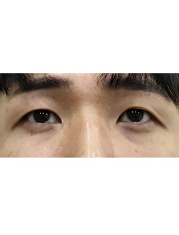 男生也能靠玻尿酸逆袭！韩国夏恩医院眼下+颧骨填充，get立体男神脸