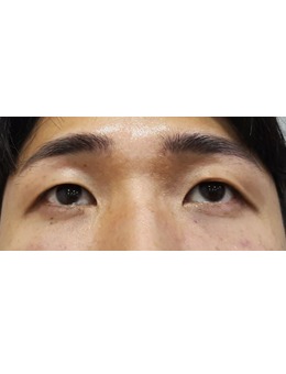 男生也能靠玻尿酸逆袭！韩国夏恩医院眼下+颧骨填充，get立体男神脸