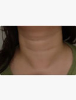 告别“年轮颈”！韩国爱丽儿整形外科颈纹改善全案，从松弛沟壑到天鹅颈的蜕变_术前