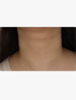 告别“年轮颈”！韩国爱丽儿整形外科颈纹改善全案，从松弛沟壑到天鹅颈的蜕变_术后