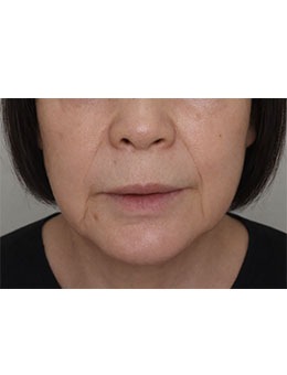 八字纹深显老10岁、面部松垮没精神？韩国爱丽儿整形外科面部填充自然淡纹细节_术前