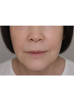 八字纹深显老10岁、面部松垮没精神？韩国爱丽儿整形外科面部填充自然淡纹细节_术后