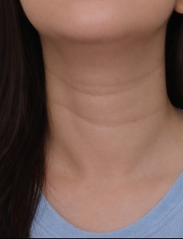 韩国爱丽儿整形外科颈纹改善病例解析:告别颈纹困扰,解锁天鹅颈