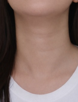 韩国爱丽儿整形外科颈纹改善病例解析:告别颈纹困扰,解锁天鹅颈