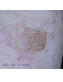 韩国仁川媄琳皮肤科反馈对比图：BBL激光祛斑，肤色不均不再是困扰