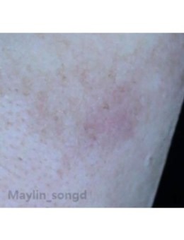 韩国仁川媄琳皮肤科反馈对比图：BBL激光祛斑，肤色不均不再是困扰