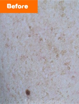 韓國仁川媄琳皮膚科祛斑前后對比照，斑點淡化明顯膚色均勻，真實結果一看便知！