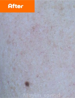 韓國仁川媄琳皮膚科祛斑前后對比照，斑點淡化明顯膚色均勻，真實結果一看便知！