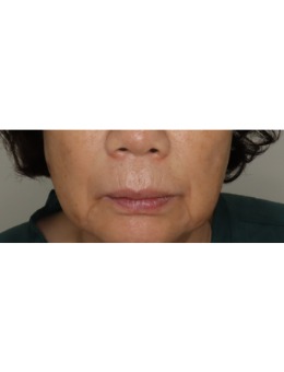 韓國(guó)愛(ài)麗兒整形抗衰上大分！來(lái)看我面部填充從垮臉到緊致的逆襲