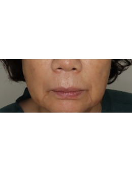 韓國(guó)愛(ài)麗兒整形抗衰上大分！來(lái)看我面部填充從垮臉到緊致的逆襲