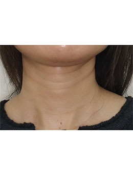 韓國愛麗兒整形去頸紋嘎嘎好！在韓本土可是非常受歡迎的整形外科呢！