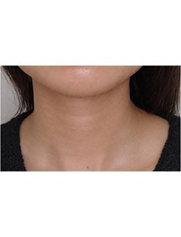 韓國愛麗兒整形去頸紋嘎嘎好！在韓本土可是非常受歡迎的整形外科呢！