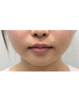 韓國greeny皮膚科豐唇術(shù)例欣賞，喬雅登玻尿酸get媽生感微笑唇！