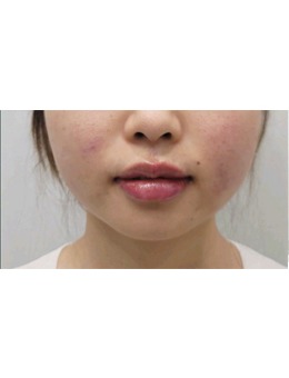 韓國greeny皮膚科豐唇術(shù)例欣賞，喬雅登玻尿酸get媽生感微笑唇！