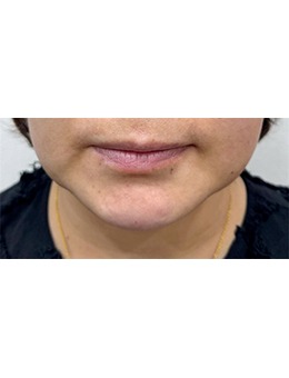 韓國(guó)GREENY皮膚科唇部填充前后對(duì)比:干癟唇→甜欲微笑唇,媽生感絕了