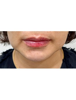 韓國(guó)GREENY皮膚科唇部填充前后對(duì)比:干癟唇→甜欲微笑唇,媽生感絕了