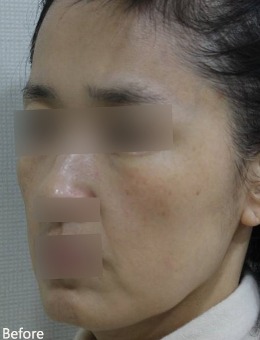 韓國ever皮膚科全臉填充物實例拆解，改善面部干癟沒元氣、輪廓線條垮塌！