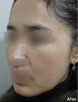 韓國ever皮膚科全臉填充物實例拆解，改善面部干癟沒元氣、輪廓線條垮塌！