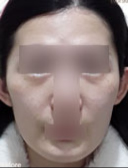 驚爆！韓國EVER皮膚科以創(chuàng)新美學(xué)理念、精細(xì)分層注射，讓面部從干癟骨相秒變流暢鵝蛋臉