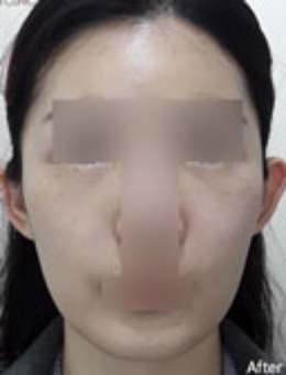 驚爆！韓國EVER皮膚科以創(chuàng)新美學(xué)理念、精細(xì)分層注射，讓面部從干癟骨相秒變流暢鵝蛋臉