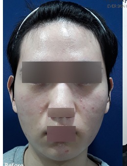 韓國EVER皮膚科男士聯(lián)合治療蛻變術(shù)例解析:告別生硬輪廓,解鎖柔和線條